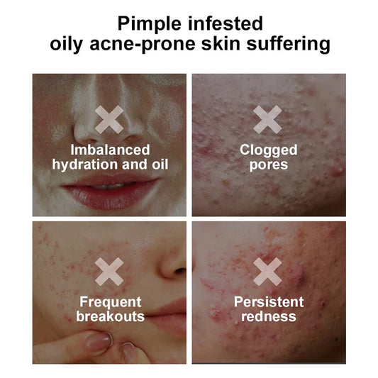 Creme para limpeza Pele e remoção de Acnes